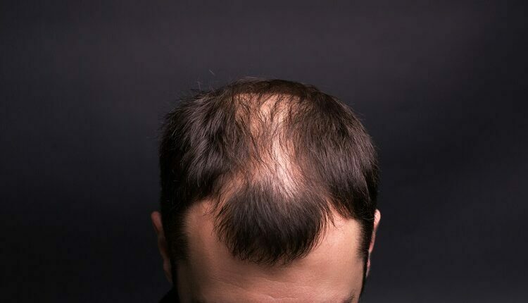 How To Fix Bald Spots And Regrow New Hair In Men